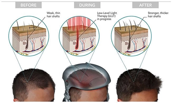 Low-level laser therapy